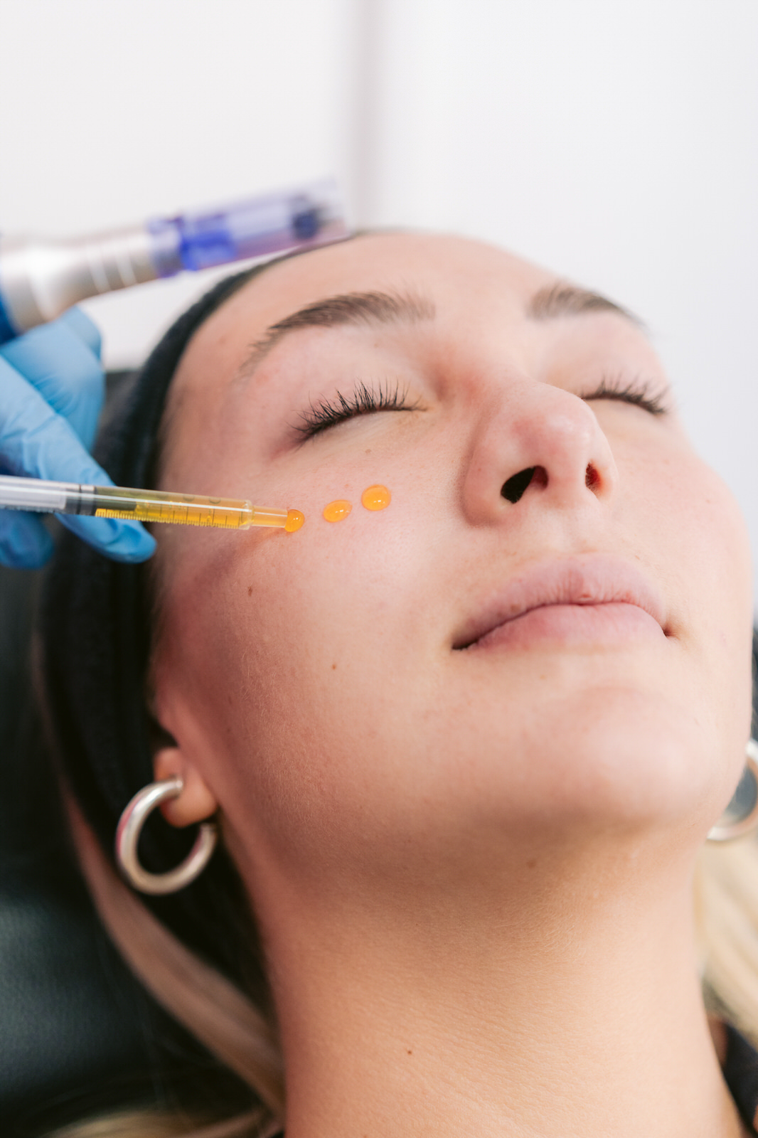 CDM Medical — Purasomes agujas rostro primer plano