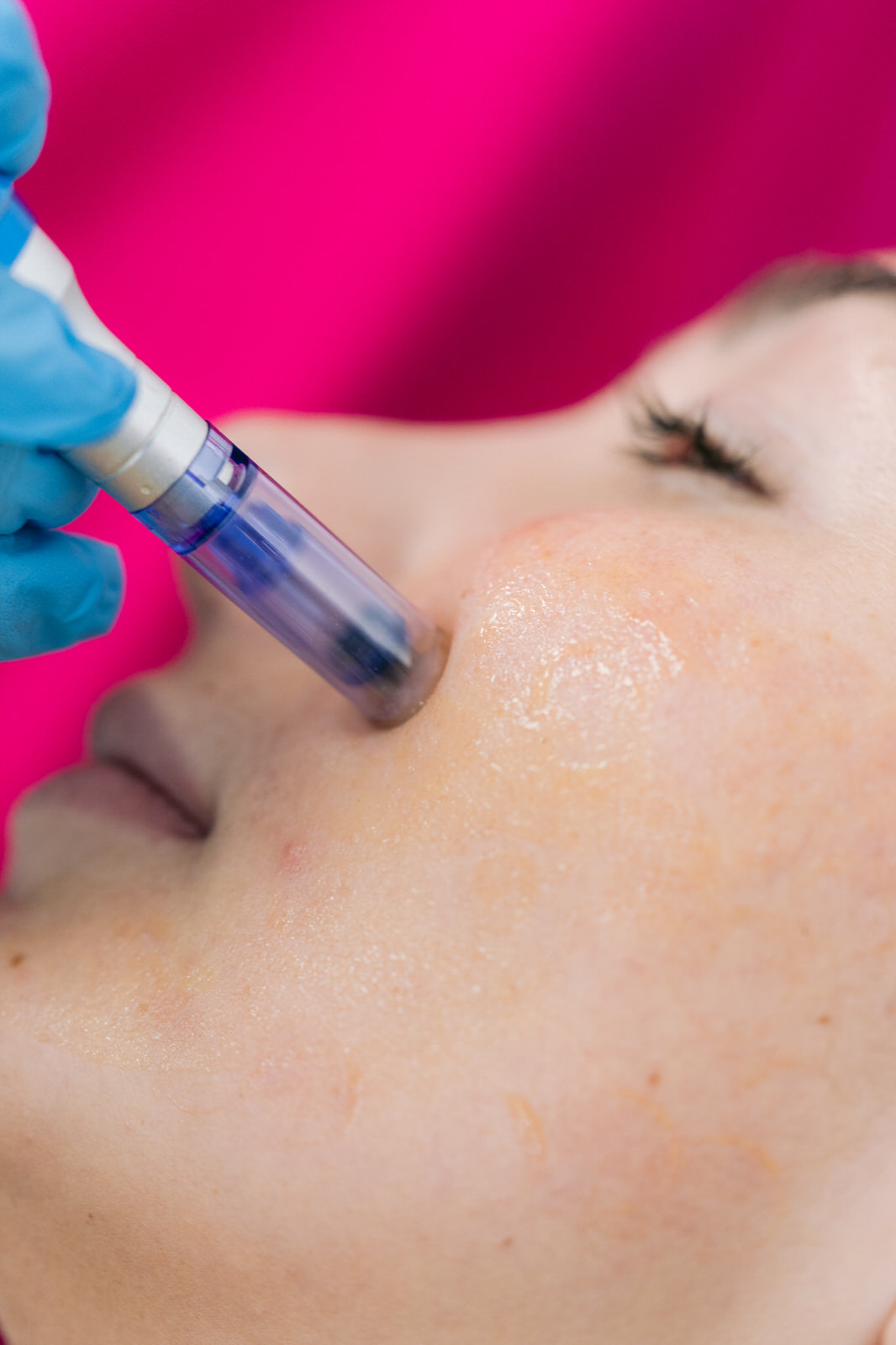 CDM Medical — Purasomes aplicacion mejilla dispositivo